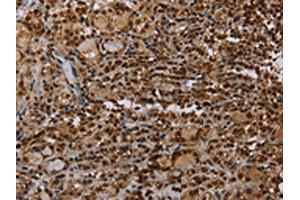 The image on the left is immunohistochemistry of paraffin-embedded Human thyroid cancer tissue using ABIN7192743(TBX5 Antibody) at dilution 1/35, on the right is treated with synthetic peptide. (T-Box 5 antibody)