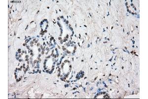 Immunohistochemical staining of paraffin-embedded Adenocarcinoma of colon tissue using anti-SLC7A8mouse monoclonal antibody. (SLC7A8 antibody)