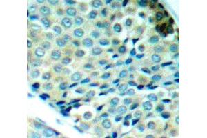 Immunohistochemistry of paraffin-embedded human breast carcinoma using Phospho-HSPB1-S78 antibody (ABIN2987689). (HSP27 antibody  (pSer78))