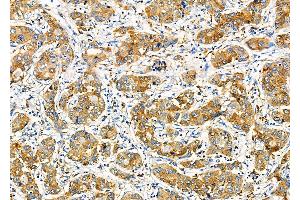 ABIN6260181 and ABIN6277800 at 1/100 staining Human liver cancer by IHC-P.