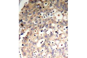 Immunohistochemistry of paraffin-embedded human breast carcinoma tissue, using Phospho-PTPN6-Y536 antibody (ABIN2988271).