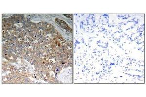 Immunohistochemical analysis of paraffin-embedded human breast carcinoma tissue using GSK3α/β(Phospho-Tyr279/216) Antibody (left) or the same antibody preincubated with blocking peptide (right). (Glycogen Synthase Kinase 3 (GSK3) (pTyr216), (pTyr279) antibody)