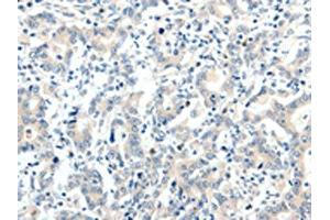 The image on the left is immunohistochemistry of paraffin-embedded Human gastric cancer tissue using ABIN7192880(TRAF7 Antibody) at dilution 1/20, on the right is treated with synthetic peptide. (TRAF7 antibody)