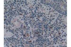 DAB staining on IHC-P; Samples: Human Skin cancer Tissue (HMOX1 antibody  (AA 61-172))