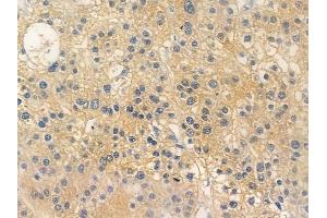 ABIN6256624 and ABIN6267265 at 1/100 staining human hepatocellular carcinoma by IHC-P. (EGFR antibody  (pTyr1173, pTyr1197))