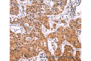 Immunohistochemistry of Human lung cancer using IL1RL1 Polyclonal Antibody at dilution of 1:70 (IL1RL1 antibody)