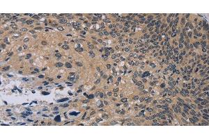 Immunohistochemistry of paraffin-embedded Human cervical cancer tissue using NOX1 Polyclonal Antibody at dilution 1:50 (NOX1 antibody)