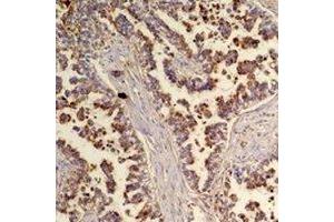 Immunohistochemical analysis of Flotillin 2 staining in human lung cancer formalin fixed paraffin embedded tissue section. (Flotillin 2 antibody)