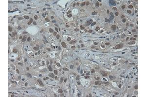 Immunohistochemical staining of paraffin-embedded Carcinoma of liver using anti-HNF6 (ABIN2452681) mouse monoclonal antibody.