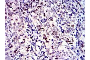 Immunohistochemical analysis of paraffin-embedded cervical cancer tissues using BIRC5 mouse mAb with DAB staining. (Survivin antibody)