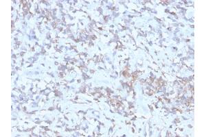 Formalin-fixed, paraffin-embedded human Hepatocellular Carcinoma stained with RBP1 Recombinant Mouse Monoclonal Antibody (rRBP1/872).