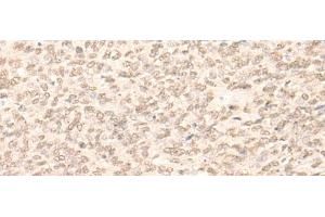 Immunohistochemistry of paraffin-embedded Human ovarian cancer tissue using RBM17 Polyclonal Antibody at dilution of 1:35(x200) (RBM17 antibody)