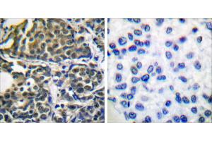 Peptide - +Immunohistochemical analysis of paraffin-embedded human breast carcinoma tissue using HSP90B (Ab-254) antibody (#B0013). (HSP90AB1 antibody  (Ser254))