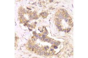 Immunohistochemistry of paraffin-embedded Human mammary cancer using CTNND1 antibody at dilution of 1:100 (x400 lens). (CTNND1 antibody)