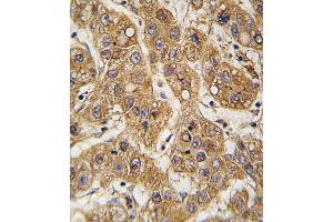 Formalin-fixed and paraffin-embedded human hepatocarcinoma tissue reacted with OE antibody (C-term) 7587b , which was peroxidase-conjugated to the secondary antibody, followed by DAB staining. (APOE antibody  (C-Term))