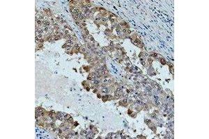 Immunohistochemical analysis of HSP70 staining in human lung cancer formalin fixed paraffin embedded tissue section. (HSP70 antibody)