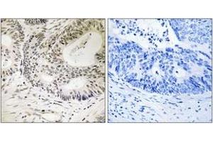 Immunohistochemistry analysis of paraffin-embedded human colon carcinoma, using 53BP1 (Phospho-Ser25) Antibody. (TP53BP1 antibody  (pSer25))