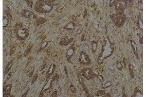 Immunohistochemical analysis of paraffin-embedded Human Breast Caricnoma using Phosphoserine Mouse mAb diluted at 1:200. (Phosphoserine antibody)