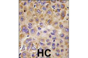 Formalin-fixed and paraffin-embedded human hepatocarcinoma tissue reacted with PFKFB1 antibody , which was peroxidase-conjugated to the secondary antibody, followed by DAB staining. (PFKFB1 antibody  (AA 259-289))