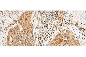 Immunohistochemistry of paraffin-embedded Human esophagus cancer tissue using GTF2H4 Polyclonal Antibody at dilution of 1:25(x200) (GTF2H4 antibody)