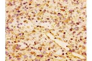 Immunohistochemistry of paraffin-embedded human glioma using ABIN7145966 at dilution of 1:100 (CCL17 antibody  (AA 24-94))