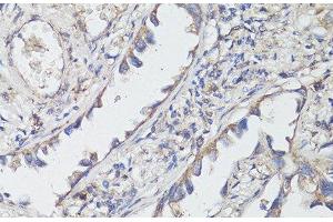 Immunohistochemistry of paraffin-embedded Human lung cancer using TrkB Polyclonal Antibody at dilution of 1:200 (40x lens). (TRKB antibody)