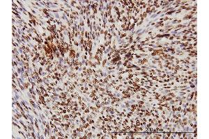 Immunoperoxidase of monoclonal antibody to TARDBP on formalin-fixed paraffin-embedded human leiomyosarcoma tissue [antibody concentration 3 ug/ml] (TARDBP antibody  (AA 1-260))