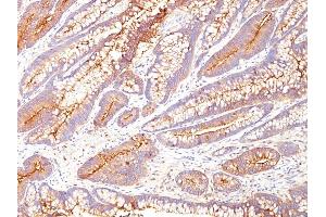 Formalin-fixed, paraffin-embedded human Colon Carcinoma stained with CEA Mouse Monoclonal Antibody (COL-1). (CEACAM5 antibody)