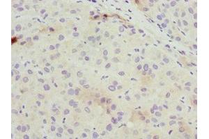 Immunohistochemistry of paraffin-embedded human liver cancer using ABIN7162309 at dilution of 1:100 (Osteocalcin antibody  (AA 52-100))