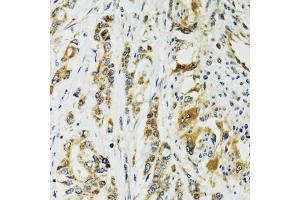 Immunohistochemistry of paraffin-embedded human colon carcinoma using TNNC1 antibody. (TNNC1 antibody)