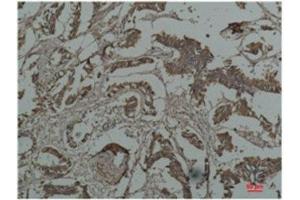 Immunohistochemistry (IHC) analysis of paraffin-embedded Human Breast Carcicnoma using HSP27 Mouse Monoclonal Antibody diluted at 1:200. (Cyclin B1 antibody)