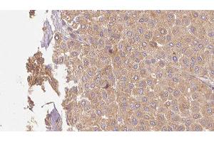 ABIN6273509 at 1/100 staining Human Melanoma tissue by IHC-P. (GZMM antibody  (Internal Region))