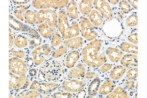 ABIN6260819 and ABIN6276752 at 1/100 staining Human kidney cancer and adjacent normal tissues by IHC-P.