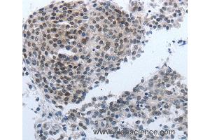 Immunohistochemistry of Human liver cancer using NPR1 Polyclonal Antibody at dilution of 1:40 (NPR1 antibody)