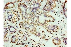 Immunohistochemistry of paraffin-embedded human breast cancer using ABIN7167670 at dilution of 1:100 (RNLS antibody  (AA 18-342))