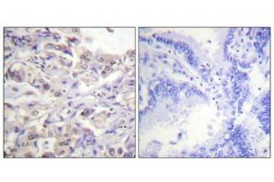 Immunohistochemical analysis of paraffin-embedded human lung carcinoma tissue using hnRPD (Phospho-Ser83) antibody (left)or the same antibody preincubated with blocking peptide (right). (HNRNPD/AUF1 antibody  (pSer83))