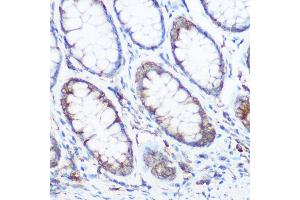Immunohistochemistry of paraffin-embedded human colon carcinoma using NOMO1 Rabbit pAb (ABIN6128346, ABIN6144710, ABIN6144711 and ABIN6214793) at dilution of 1:350 (40x lens). (NOMO1 antibody  (AA 700-1000))