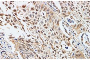 Immunohistochemistry of paraffin-embedded Human lung cancer using CDK4 Polyclonal Antibody at dilution of 1:200 (CDK4 antibody)