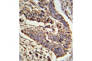 Formalin-fixed and paraffin-embedded human lung carcinoma reacted with SCNN1A Antibody (Center), which was peroxidase-conjugated to the secondary antibody, followed by DAB staining. (SCNN1A antibody  (AA 365-391))