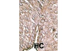 Formalin-fixed and paraffin-embedded human cancer tissue reacted with the primary antibody, which was peroxidase-conjugated to the secondary antibody, followed by DAB staining. (MAP1LC3A antibody  (AA 23-52))