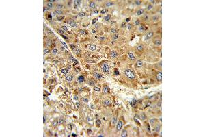 Formalin-fixed and paraffin-embedded human hepatocarcinoma reacted with GPX1 Antibody (C-term), which was peroxidase-conjugated to the secondary antibody, followed by DAB staining. (Glutathione Peroxidase 1 antibody  (C-Term))