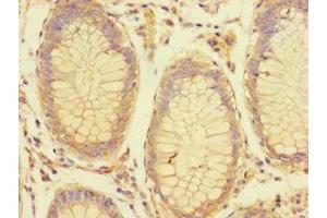 Immunohistochemistry of paraffin-embedded human colon cancer using ABIN7158198 at dilution of 1:100