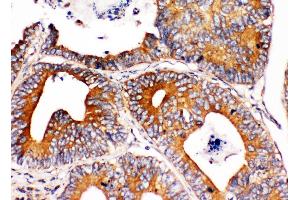 Anti-Integrin alpha 1 antibody,  IHC(P) IHC(P): Human Intestinal Cancer Tissue (Integrin alpha 1 antibody  (C-Term))