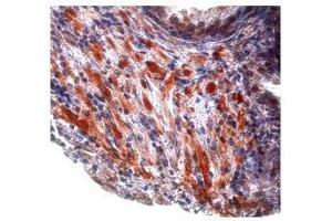Tgf beta 1 in prostate cancer was detected using TGFB1 antibody at a dilution of 5-10 ug/ml and stained with HRP/AEC red color stain. (TGFB1 antibody  (Middle Region))