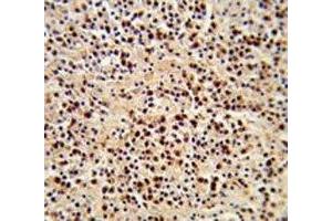 IHC analysis of FFPE human lymphoma stained with LCK antibody (LCK antibody  (AA 480-509))