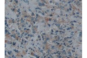 IHC-P analysis of Human Prostate cancer Tissue, with DAB staining. (ECE1 antibody  (AA 469-721))
