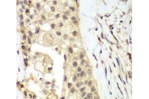 Immunohistochemistry of paraffin-embedded Human lung cancer using FGFR1 Polyclonal Antibody at dilution of 1:100 (40x lens). (FGFR1 antibody)