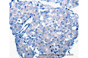 Immunohistochemistry of Human breast cancer using CCL2 Polyclonal Antibody at dilution of 1:50 (CCL2 antibody)