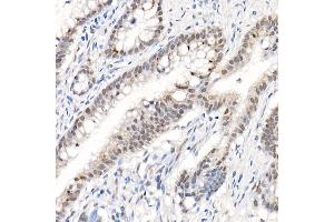 Immunohistochemistry of paraffin-embedded human colon carcinoma using Phospho--S473 Rabbit pAb (ABIN1513328, ABIN5664973, ABIN5664975 and ABIN6225474) at dilution of 1:50 (40x lens). (AKT1 antibody  (pSer473))