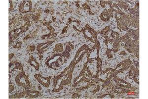 Immunohistochemistry (IHC) analysis of paraffin-embedded Human Breast Carcicnoma using GRP78/Bip Mouse Monoclonal Antibody diluted at 1:200. (GRP78 antibody)